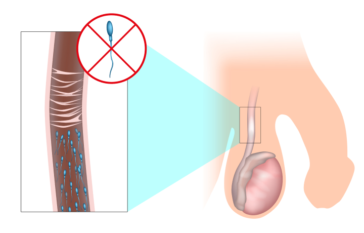 무도정관레이져 수술 및 정관 복원술이란