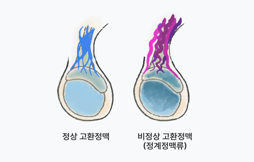 정계정맥류