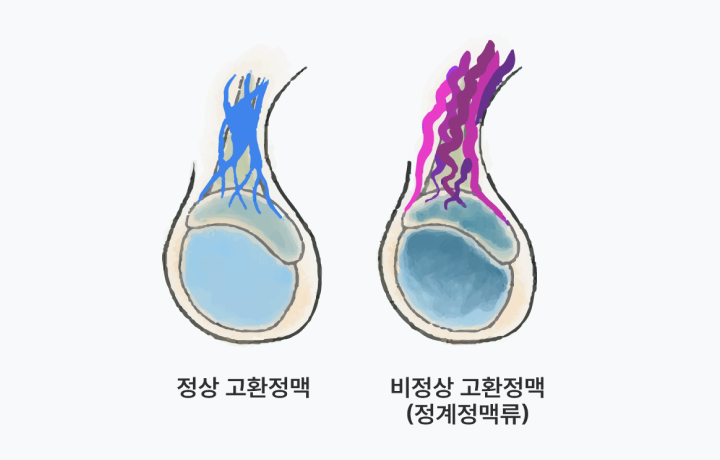 정계정맥류