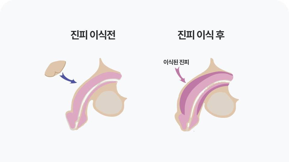 남성 임플란트 대체진피 이식