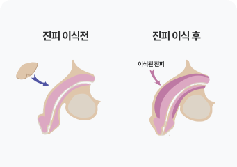 남성 임플란트 대체진피 이식