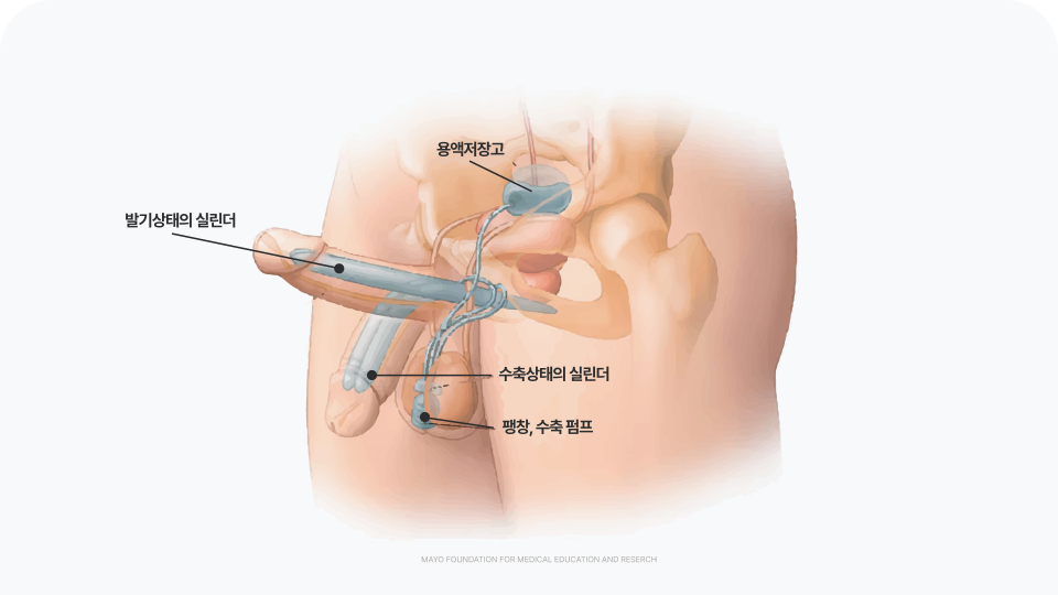 남성 임플란트 수술