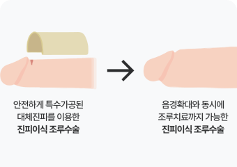조루수술