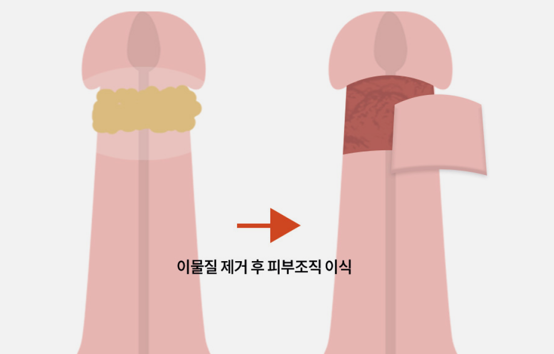 음경이물질제거수술