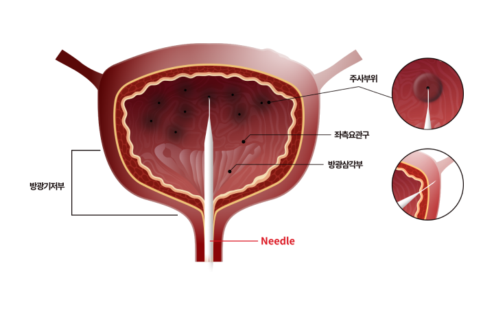 방광보톡스 시술