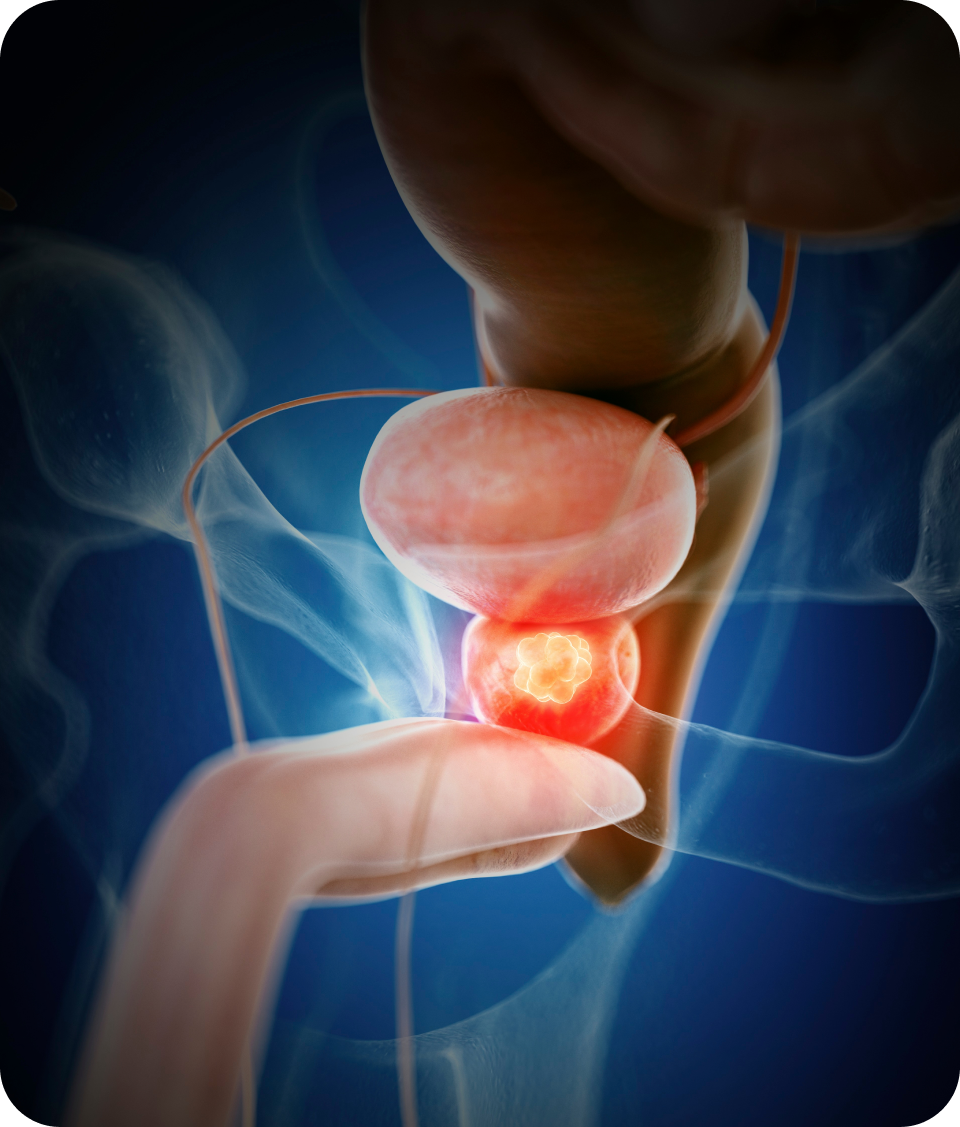 전립선염원 세균감염의 종류