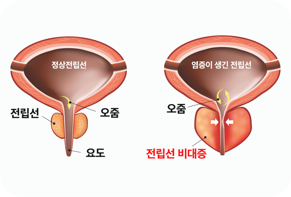 전립선비대증이란