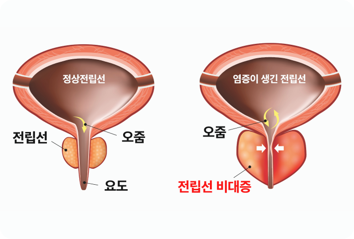 전립선비대증이란