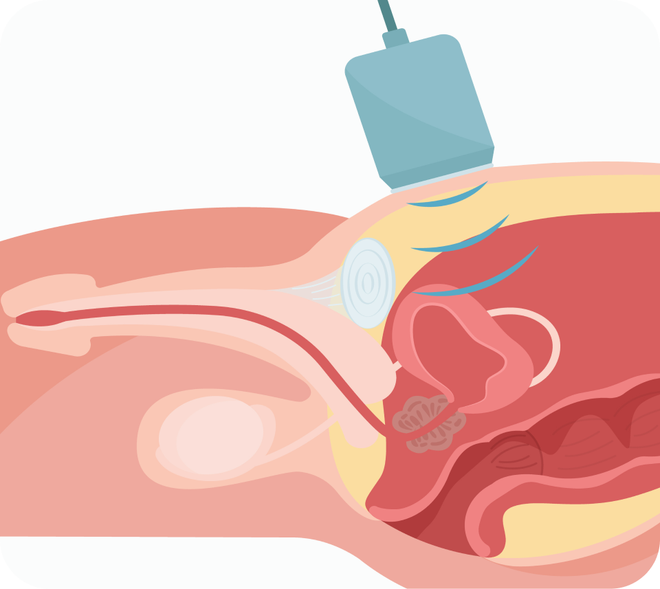 전립선 초음파 검사