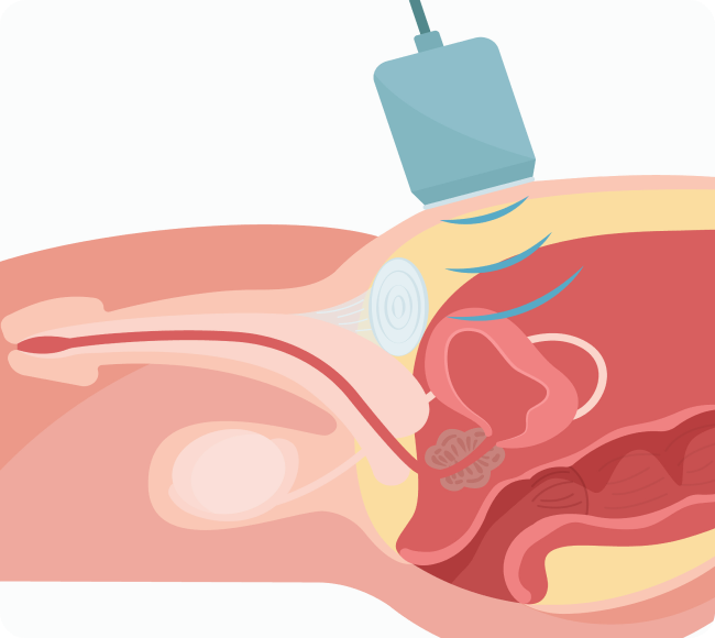 전립선 초음파 검사