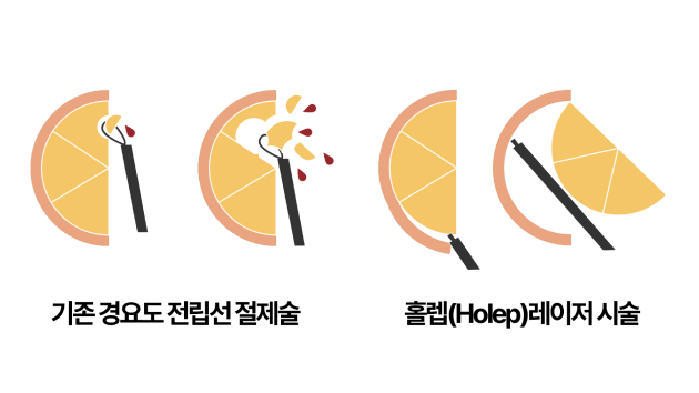 전립선비대증 수술 홀렙