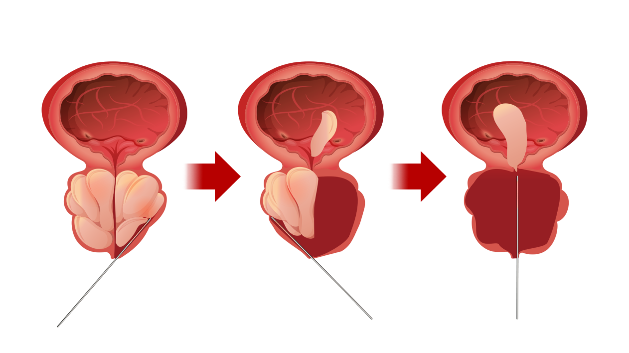 전립선비대증 수술 홀렙