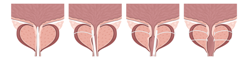 전립선비대증 수술 유로리프트