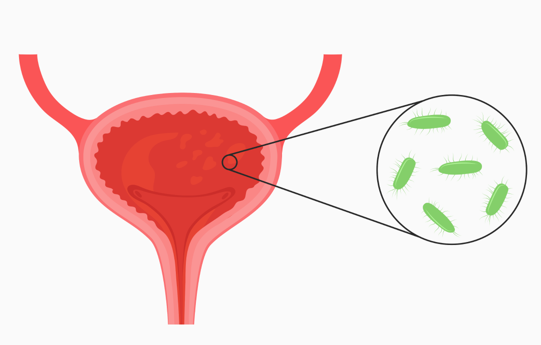 방광내막의 염증
